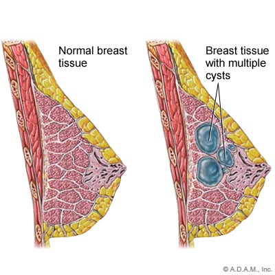 Gla Bantu Pengecutan Cyst Payudara Breast Cyst
