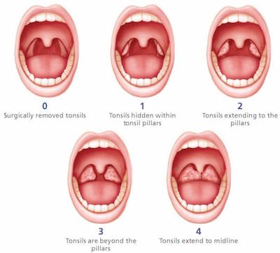tonsil kanak bengkak bahaya tonsils grading enlarged sedikit obstructive diambil peranan kemudian alih