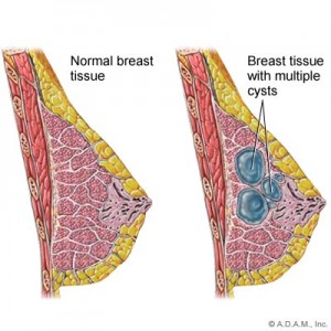 breast-cysts-1.jpg