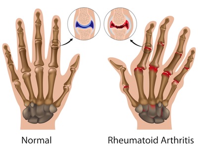 vivix-mengurangkan-rheumatoid-arthritis