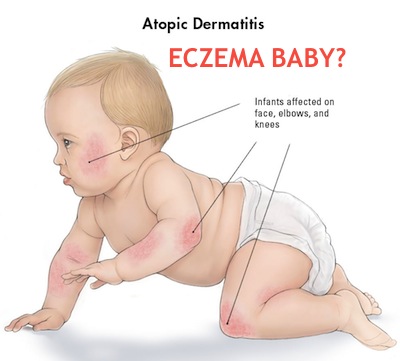 Eczema Baby Bukan Ruam Biasa  GenkiMomma