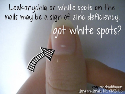 khasiat-zinc-leukonychia-white-spots
