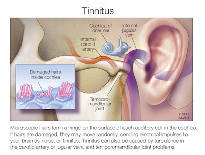 punca-tinnitus-luka-cochlea