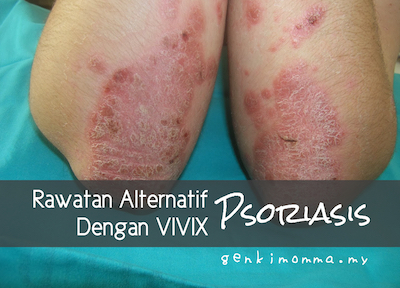rawatan-psoriasis-vivix-shaklee