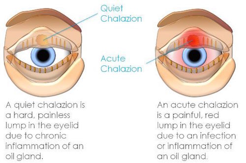 Ketumbit Mata Chalazion